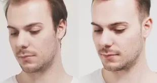 Hair Transplant in Pakistan