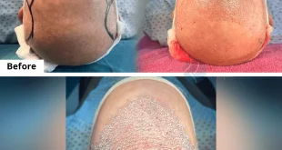 best hair transplant in pakistan