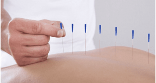 Acupuncture Therapy