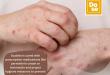 What is the strongest treatment for scabies?