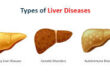 Types of Liver Disease