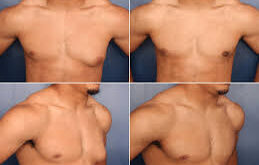 gynecomastia surgery lahore